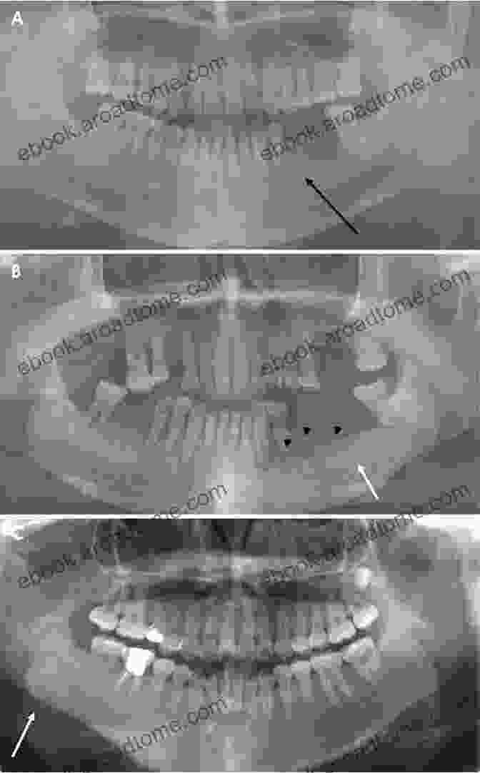 A Panoramic Radiograph Showing Osteomyelitis Involving The Mandible And Maxilla. Comprehensive Maxillofacial Osteomyelitis