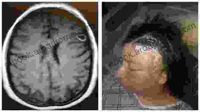 A Young Woman With A Brain Tumor Reduced To Madness: One Girl S Story About Surviving A Brain Tumor Postoperative PTSD