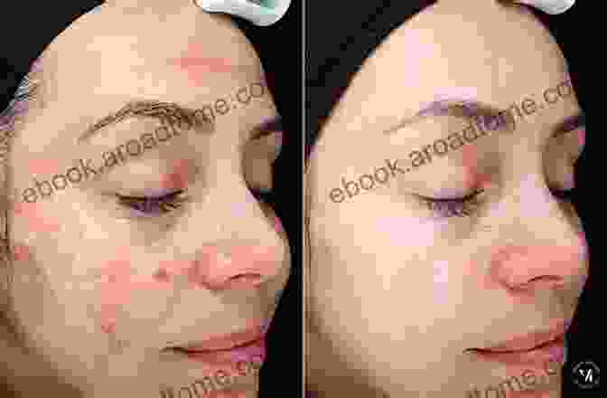 Before And After Photos Showing The Results Of A Chemical Peel The Art Of Facial Aesthetics