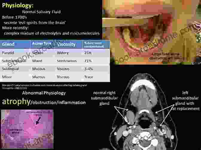 Case Study Of Sialendoscopy Sialendoscopy An Issue Of Atlas Of The Oral Maxillofacial Surgery Clinics (The Clinics: Dentistry 26)