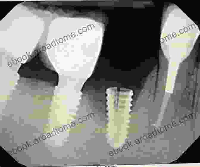 Diagram Of Implant Fracture, A Complication Where The Dental Implant Breaks Biological And Hardware Complications In Implant Dentistry (ITI Treatment Guide 8)