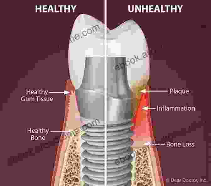 Diagram Of Peri Implantitis, A Bacterial Infection Around A Dental Implant Biological And Hardware Complications In Implant Dentistry (ITI Treatment Guide 8)