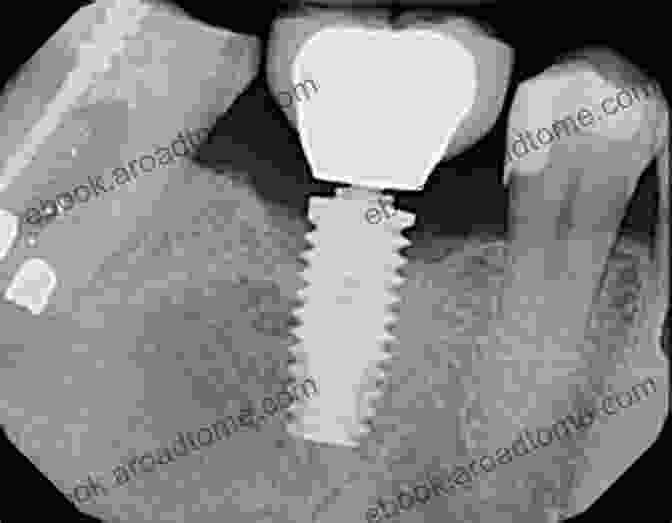 Diagram Of Screw Loosening, A Complication Where The Screw Holding A Dental Implant In Place Becomes Loose Biological And Hardware Complications In Implant Dentistry (ITI Treatment Guide 8)