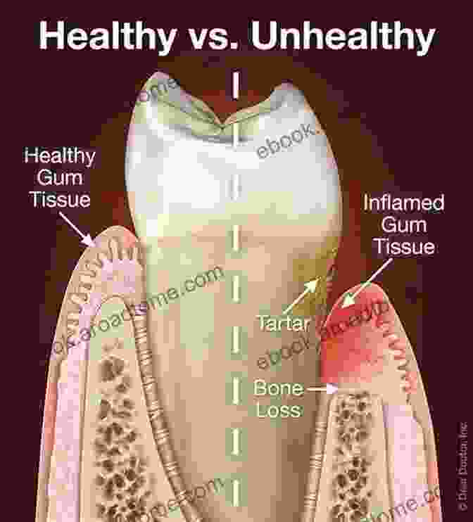 Diagram Of Soft Tissue Dehiscence, A Condition Where The Gum Tissue Around A Dental Implant Recedes Biological And Hardware Complications In Implant Dentistry (ITI Treatment Guide 8)