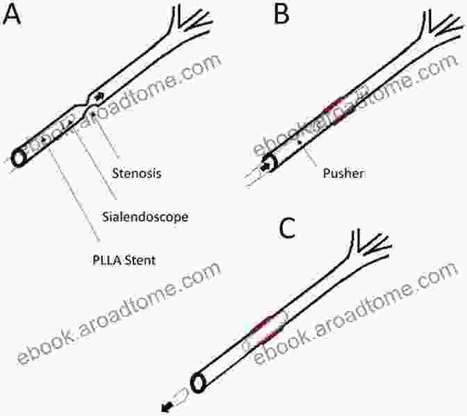 Diagram Of Therapeutic Applications Of Sialendoscopy Sialendoscopy An Issue Of Atlas Of The Oral Maxillofacial Surgery Clinics (The Clinics: Dentistry 26)