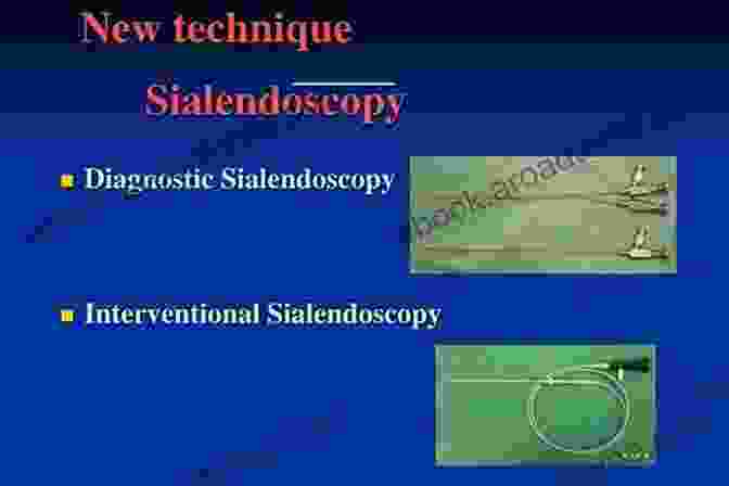 Illustration Of Sialendoscopy Techniques Sialendoscopy An Issue Of Atlas Of The Oral Maxillofacial Surgery Clinics (The Clinics: Dentistry 26)