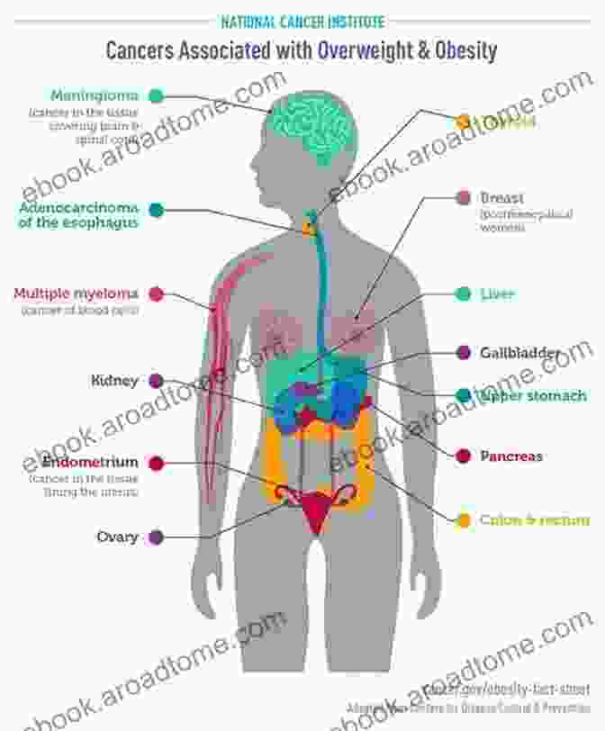 Obesity And Colorectal Cancer Obesity And Gastroenterology An Issue Of Gastroenterology Clinics Of North America (The Clinics: Internal Medicine 45)