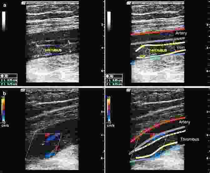 Ultrasound Imaging Of Superficial Veins Lower Extremity Superficial Venous Anatomy For Ultrasound And Doppler Diagnosis