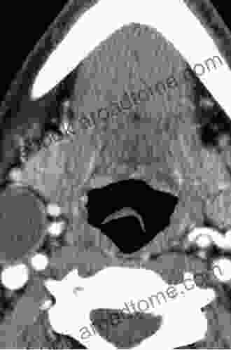 Carcinoma of the Oral Cavity and Oropharynx (Recent Results in Cancer Research 134)