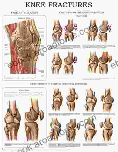 Knee Fractures Quick Reference Chart: Full Illustrated