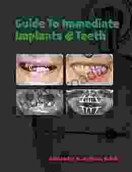 Guide To Immediate Implants And Teeth: Must Have Manual For Doctors And Patients Who Plan To Do Immediate Implants And Teeth